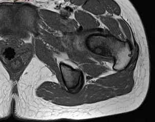 Figure 3 for case Osteoid osteoma ( RID4005 )
